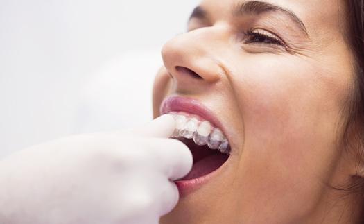 Noticia 7 Beneficios de la ortodoncia invisible 2022
